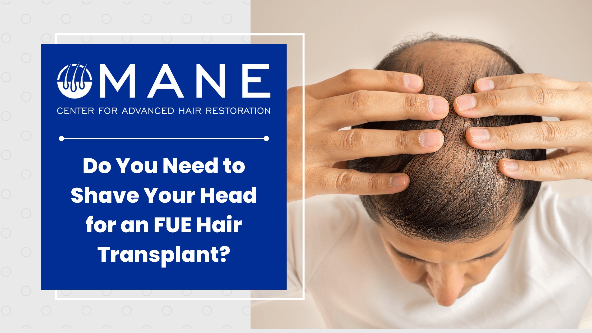 Do You Need to Shave Your Head for an FUE Hair Transplant?