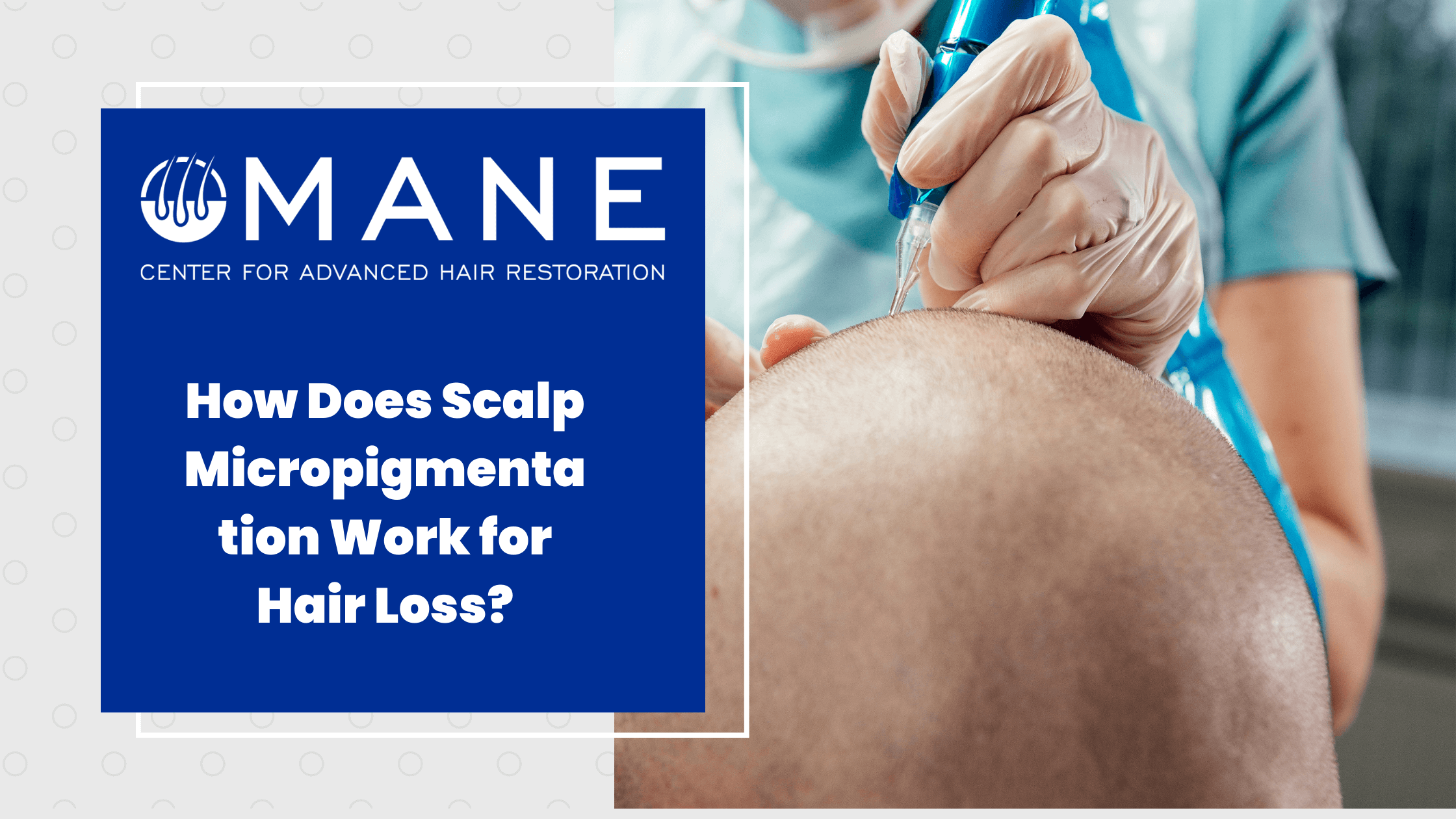 How Does Scalp Micropigmentation Work for Hair Loss?