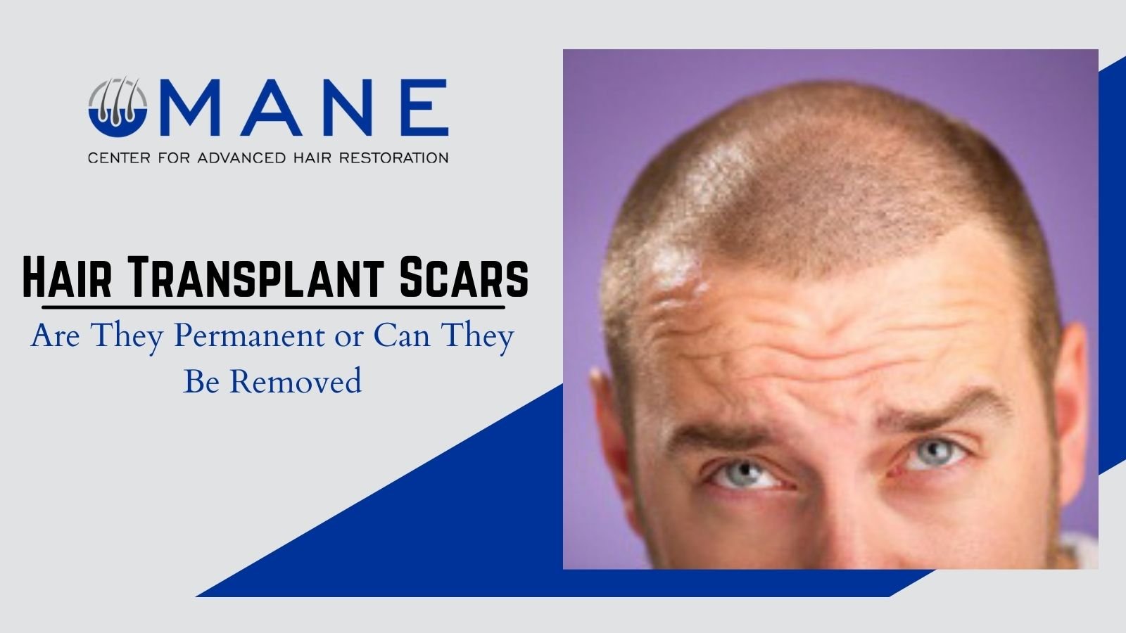 Hair Transplant Scars – Are They Permanent or Can They Be Removed
