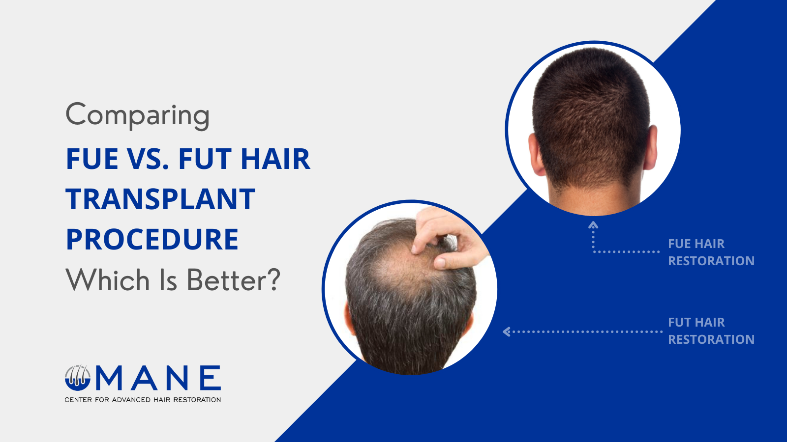 Comparing FUE vs. FUT Hair Transplant Procedure – Which is Better?
