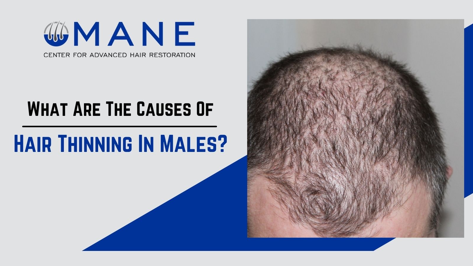 What Are The Causes Of Hair Thinning In Males?