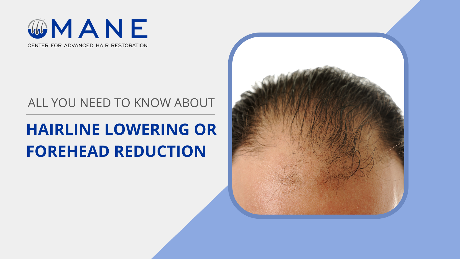 All You Need to Know about Hairline Lowering or Forehead Reduction