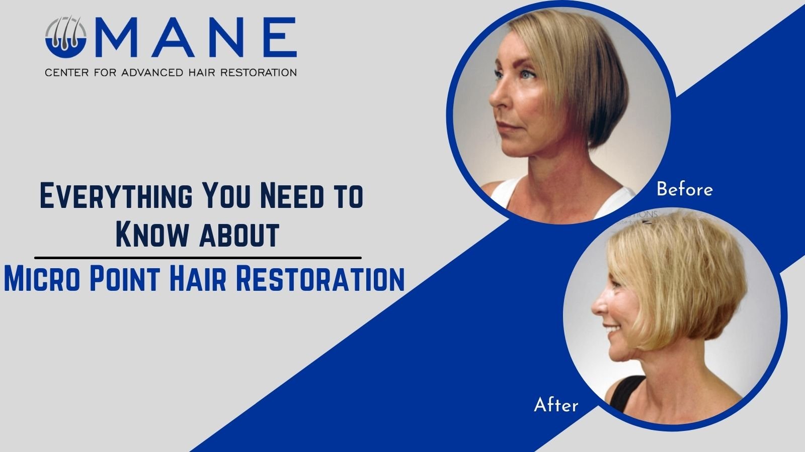 Everything You Need to Know about Micro Point Hair Restoration