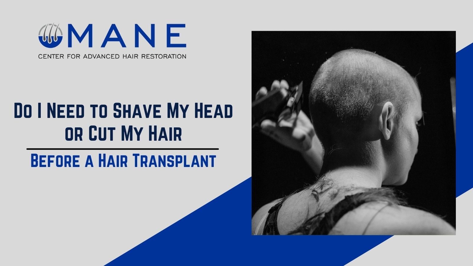 Do I Need to Shave My Head or Cut My Hair Before a Hair Transplant