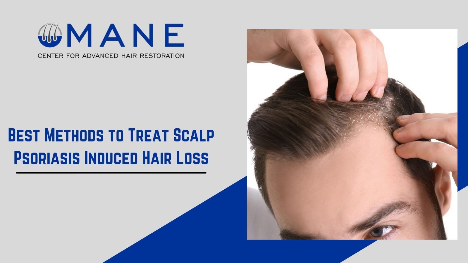 Best Methods to Treat Scalp Psoriasis Induced Hair Loss