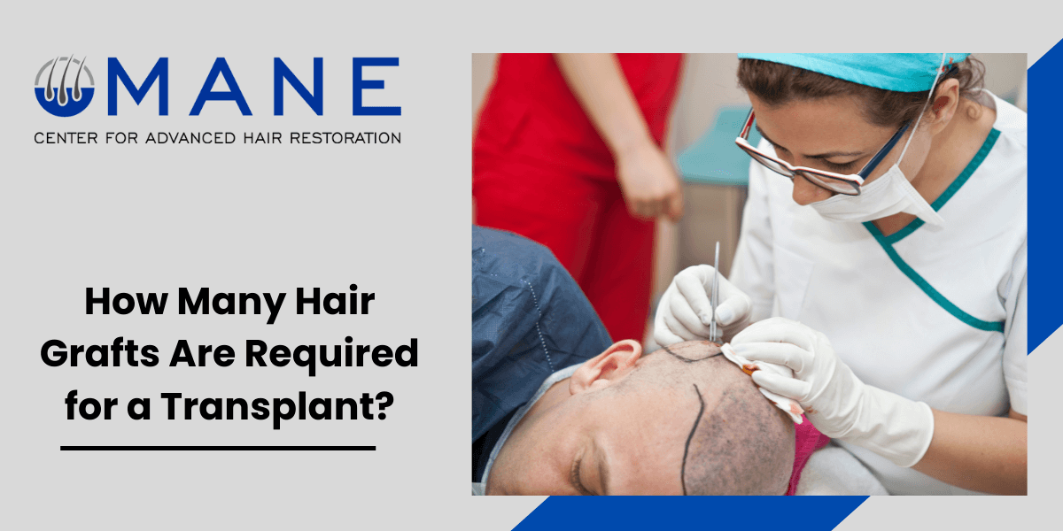 How Many Hair Grafts Are Required for a Transplant?